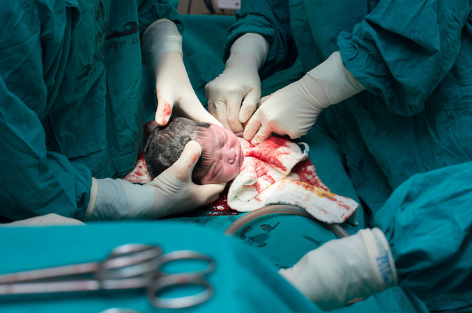 “Giờ đẹp” và những ca sinh mổ không cần thiết